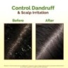 Mamaearth Lemon Anti-Dandruff Hair Oil for Flaky Scalp Scalp